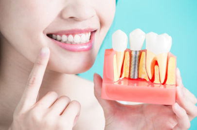 apollo dental implant cost