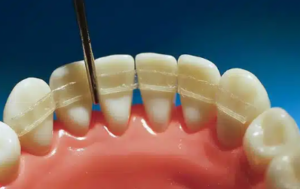 cost dental splint for loose teeth