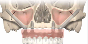 cost of zygomatic dental implants