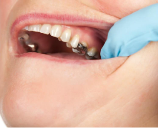 silver filling in teeth cost