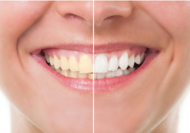 teeth whitening cost at dentist office