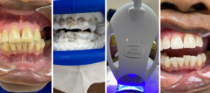 zoom whitening cost