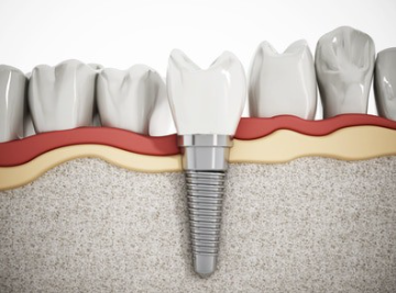 1999 dental implants