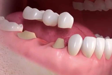 3-Unit Dental Bridge Code