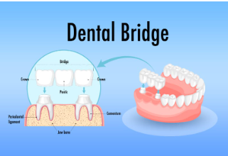 Bridge Abutment Dental Code