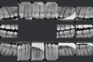 Dental Code for FMX