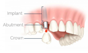 Dental Implants 39663 Zip Code