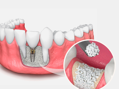 bone graft dental code