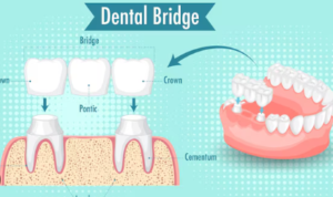 dental code bridge sectioning