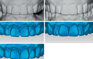 dental wax up code