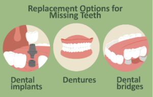 missing tooth dental code