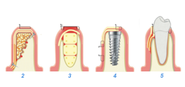 prp and prf dental code