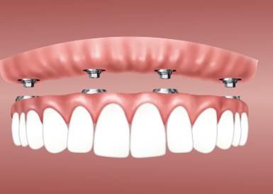 All-on-6 Dental Implants