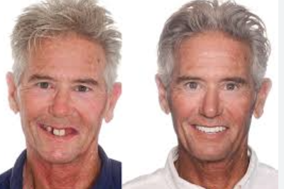 Before and After Dental Implants