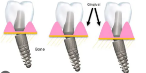 Dental Implant Abutments