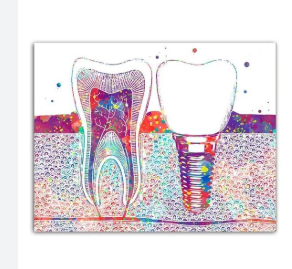 Dental Implant Art