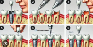 Dental Implant Procedures