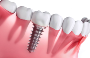 Dental Implant Surgery