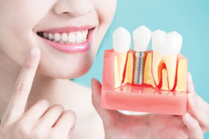 Dental Implants Aesthetic