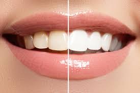 Teeth Whitening Aftercare