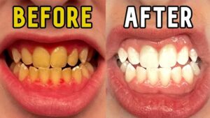 Teeth Whitening Strips Before and After