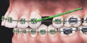 Tooth Extraction for Braces