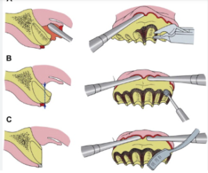 Dental Code Alveoplasty