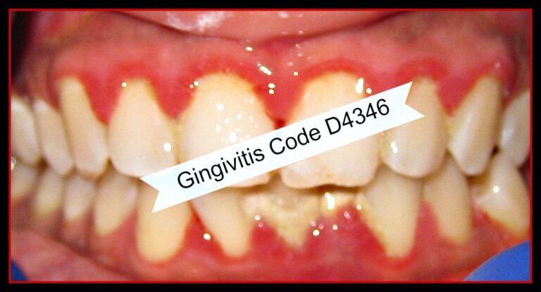 Dental Code Gingival Scaling