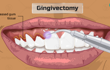 Dental Code Gingivectomy