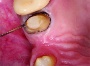 Dental Code Hemostatic Agent