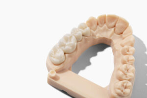 Dental Code for All-Ceramic Crowns