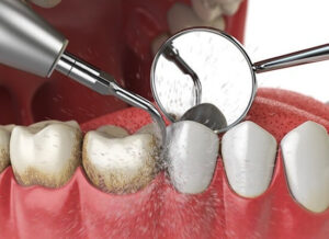 Dental Code for Gross Debridement