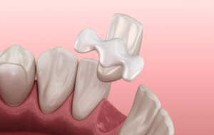 Dental Codes for Bridges