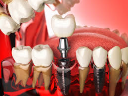 Dental Implant HS Code