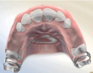 Dental Code Space Maintainers