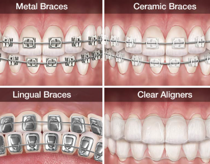 price of braces vs invisalign