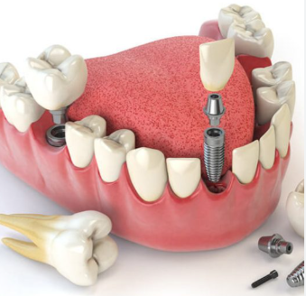 $675 Dental Implants in Michigan