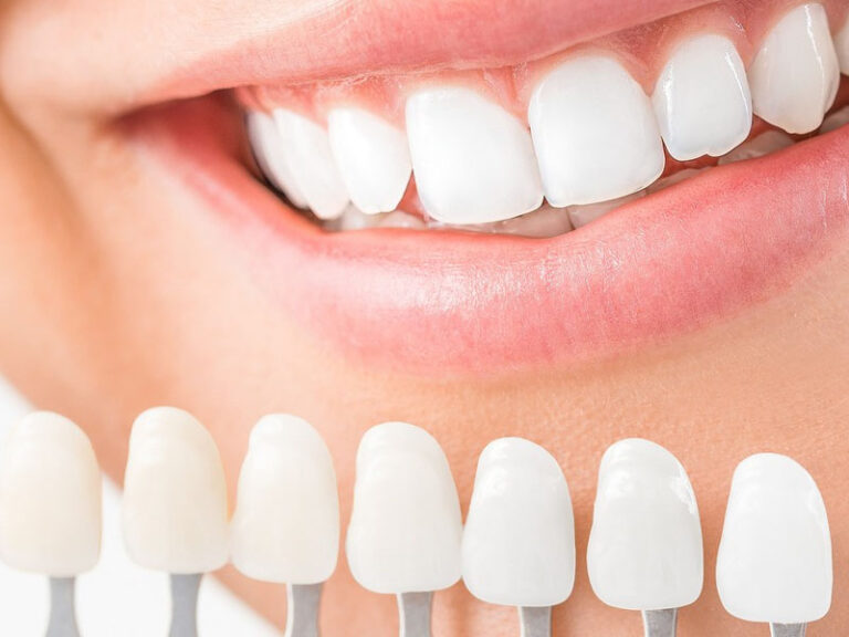 Dental Codes for Resin Composite