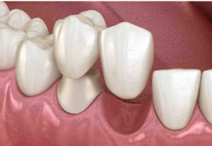 Dental Codes for Cantilever Bridges