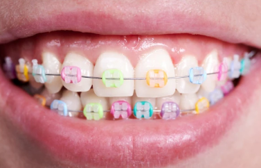 Cost of Braces for Adults in Australia