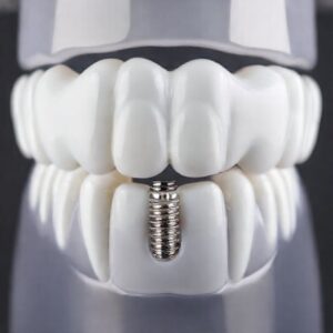 low cost dental implants in Los Angeles