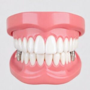 Cost of Full Arch Dental Implants