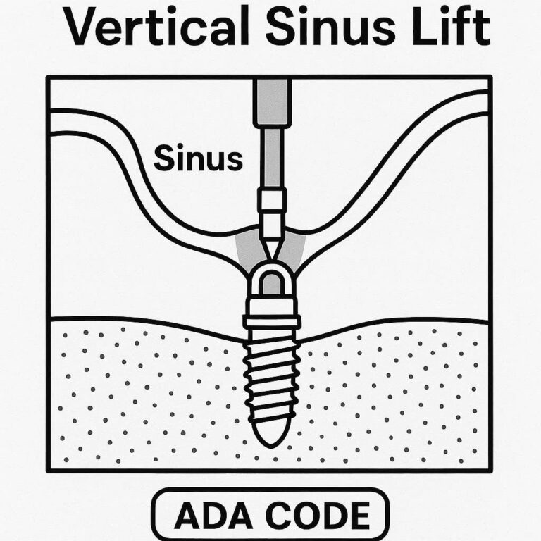 ADA Code for Vertical Sinus Lift