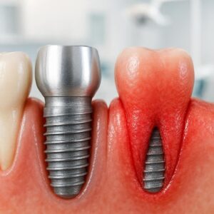 Dental Implants and Gum Disease