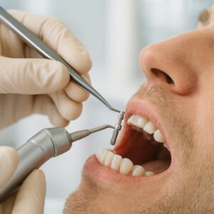 Dental Implant Preparation