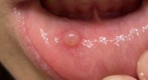 Bump on the inside of lip