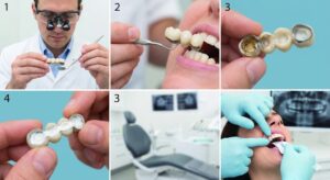 Can a Loose Dental Bridge Be Recemented?