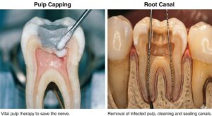 Pulp Capping vs Root Canal