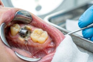 Dry Socket After Implant Placement