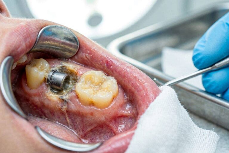 Dry Socket After Implant Placement